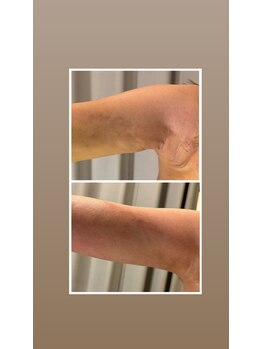 アヌヘア(Anuhea)/京都で1番のインディバ術ケア