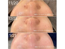 シースキン 盛岡駅前店(c.skin)の雰囲気（陶肌トリートメント3回で肌のハリ、トーンアップしました！）