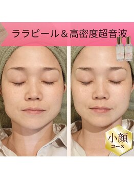 リムビューティー 自由が丘(RymBeauty)の写真/麻布十番の実績店が自由が丘へ!【期間限定キャンペーン】水光リフト+ララピールで最短小顔&うるつや水光肌