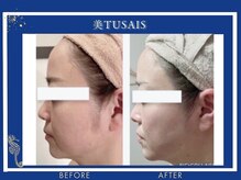 ビテュセ(美Tu sais)/小顔症例【小顔／松山／愛媛】