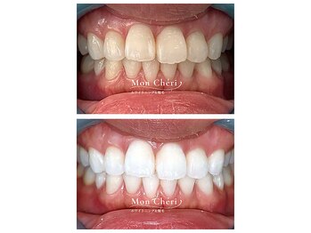 モンシェリ 広島店(Mon Cheri)/ホワイトニングBefore→After