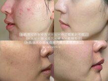 オーダーメイド施術で根本肌質改善