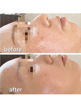 プラスワン(plusone)/人気No1のハーブピーリング