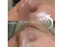 モンクラッシー(Mon classy)の雰囲気（毛穴の黒ずみ、産毛と同時に除去）