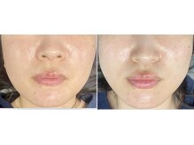 ミエリア美容鍼灸院(mielia美容鍼灸院)/カスタム美容鍼灸30本＋導入