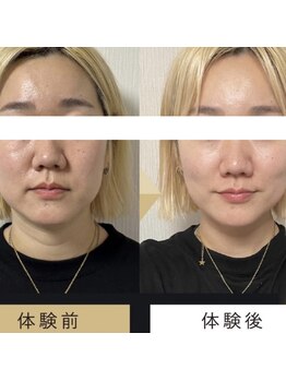 CoCoLy　【毛穴・小顔・美白ケア専門店】【10月上旬OPEN(予定)】の写真/【結果重視の小顔ケア】話題のテラボーラーで表情筋からアプローチ。スッキリとしたフェイスラインを実現♪