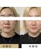 CoCoLy　【毛穴・小顔・美白ケア専門店】【10月上旬OPEN(予定)】の写真/【結果重視の小顔ケア】話題のテラボーラーで表情筋からアプローチ。スッキリとしたフェイスラインを実現♪
