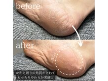 ダブリュー 今福鶴見店(W)/かかとつるつる♪角質ケア