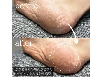ダブリュー 今福鶴見店(W)/かかとつるつる♪角質ケア