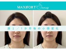 マキシフォート 名駅店(Maxifort)/週1 / 1ヶ月後の小顔変化