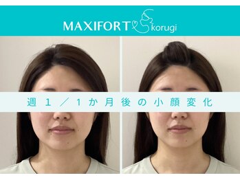 マキシフォート 名駅店(Maxifort)/週1 / 1ヶ月後の小顔変化