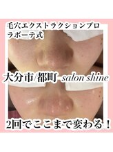 サロンシャイン(Salon Shine)/毛穴×REVI陶肌2回　20代