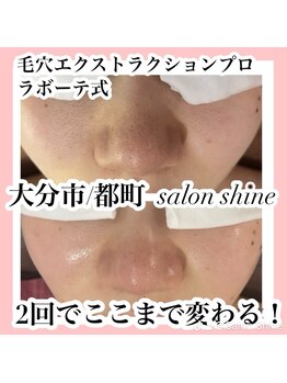 サロンシャイン(Salon Shine)/毛穴×REVI陶肌2回　20代