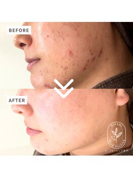 ハルミ 美容整体 新宿店(Harumi)/トラブル肌改善！