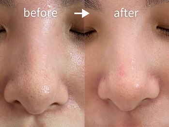 アルカンシエル(arcenciel)/毛穴改善コース