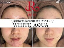 ホワイトアクア 京橋店(WHITE AQUA)/ハーブピーリング/ニキビケア