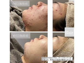 ブレア(Blair)/生ハーブピーリング