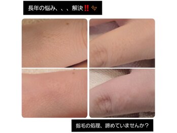 ベビースキン(baby skin)/美容電気脱毛