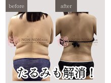 ノンノンプラス 博多(NON-NONプラス)/－10ｋｇ