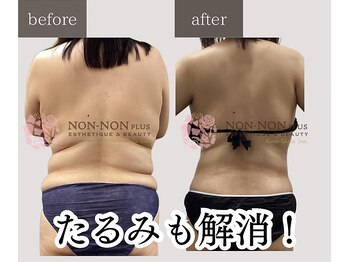 ノンノンプラス 博多(NON-NONプラス)/－10ｋｇ