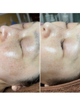 ルーチェエムベルシック(Luce.MBelChic)/ピーリングでしみも改善