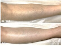 ロカビリー(Rockabilly)/メンズ　両脚脱毛