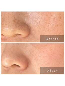 サロン ド パーフェクション(Salon de Perfection)/ブラックピーリング