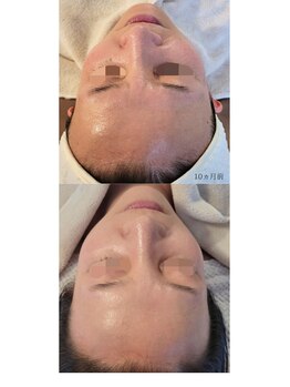 ムーフ(Moof)/施術例