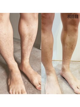 ミホノ 和泉中央店(mihono)/男性足脱毛 8回目