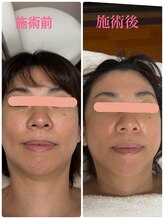 サリューベ(SALUDBE)/コラーゲンが再構築されリフトUP