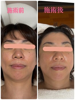 サリューベ(SALUDBE)/コラーゲンが再構築されリフトUP