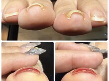 サロンドボーテ ル リアン(Salon de beaute Le Lien)の雰囲気（巻き爪でお悩みの方はお気軽にご相談ください！）