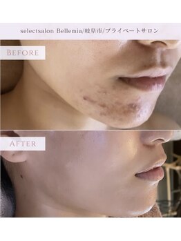 ベルミア(Bellemia)/肌荒れ、ニキビ予防★