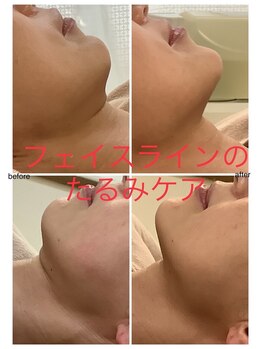 エスティ 京都店/たるみ改善before/after