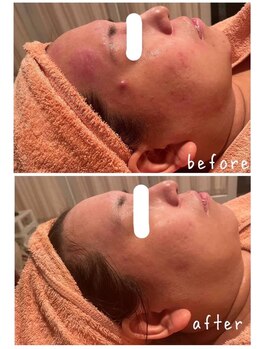 ビトタン 倉敷本店(+美to鍛)/ハーブピーリング/5回