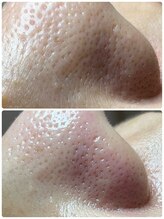 マリアム(mariam)/毛穴エクストラクションの効果