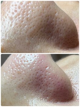 マリアム(mariam)/毛穴エクストラクションの効果