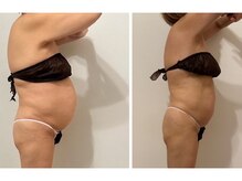 グラチア(Gratiae)の雰囲気（50代/3ヶ月12回痩身コース経過後。お腹周り－12センチ☆）