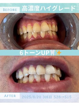 アミュホワイトニング/医療提携ホワイトニング