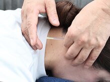 ティグリス(TIGRIS)/鍼療法です。