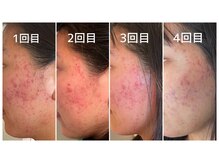 ウンジョルノ フェリーチェ 表参道店/コルギ（骨気）で小顔＆美肌！