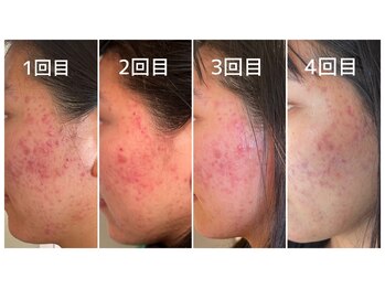 ウンジョルノ フェリーチェ 表参道店/コルギ(骨気)で小顔&美肌!