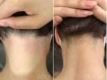 エヴァワックス 恵比寿店(Eva Wax)/【うなじ脱毛】ビフォ-アフタ-