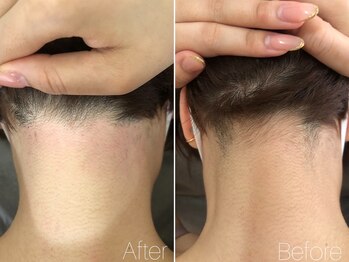 エヴァワックス 恵比寿店(Eva Wax)/【うなじ脱毛】ビフォ-アフタ-