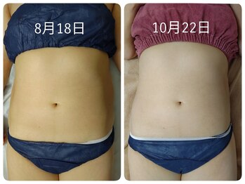 ティアス(t-us)/【痩身】強力ラジオ波