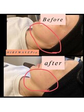 ティアメディカル(Tia Medical)/HIRFWAVEPro