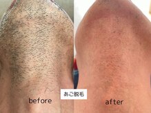 コンフィ(Comfy)の雰囲気（都度お客様の体調、肌様子を確認し脱毛レベルを調整しております）