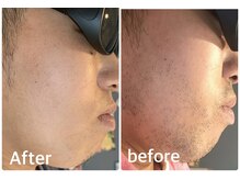 メンズ シャンティ(Men s SHANTI)/【30代男性】脱毛　Before/after