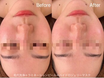 リアン(Lien)/水光肌ピーリング