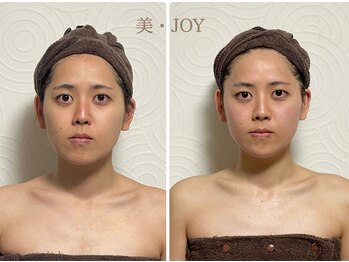 美 ジョイ(美 JOY)/小顔コルギ　施術例